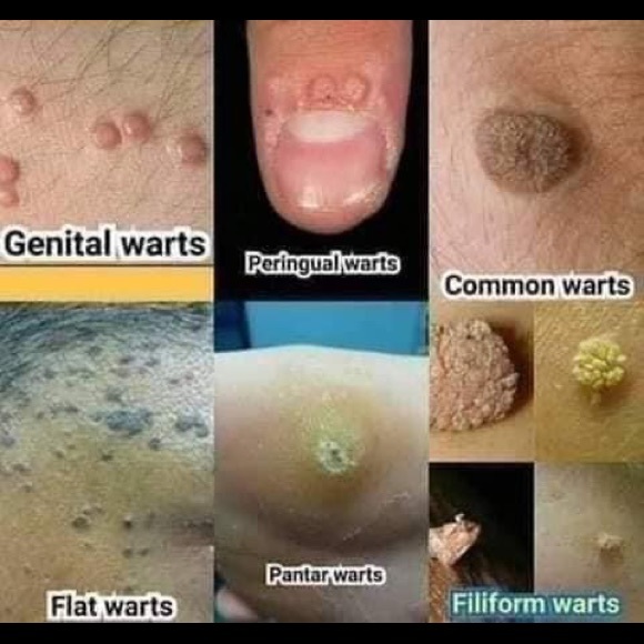 Kasoy Cream by Angel Touch skin tag keloid milia - Picture 4 of 9